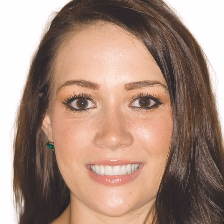 After: Ten minimal-preparation porcelain veneers