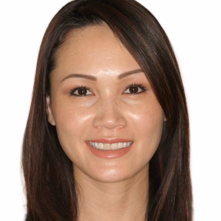 Before: Upper and lower veneers with posterior crowns